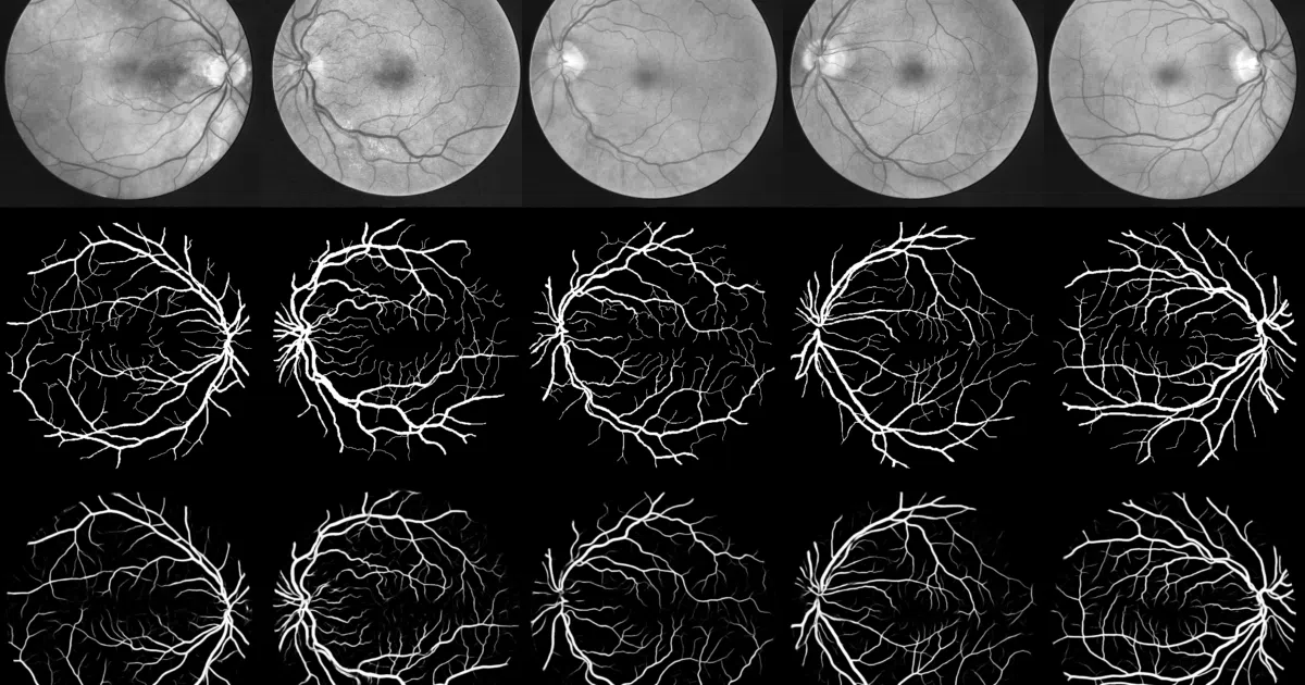 retina-unet